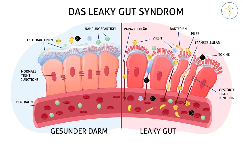 Beschriftete Illustration eines Leaky Gut Syndroms